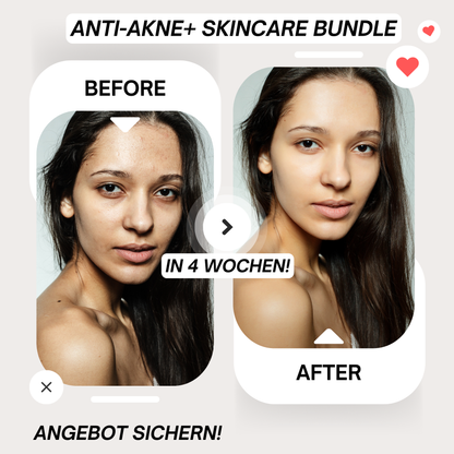 Anti-Acne+ Skincare Bundle (Clear Skin in 2 Weeks) - Marcival Hill