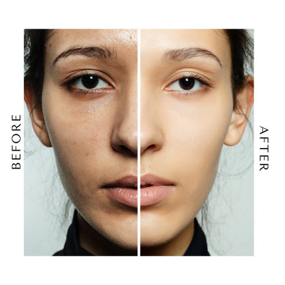 Super Anti-Breakout Serum | with BHA, Tea Tree Oil & Antioxidants